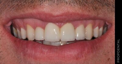Forma de los dientes de la prótesis de circonio