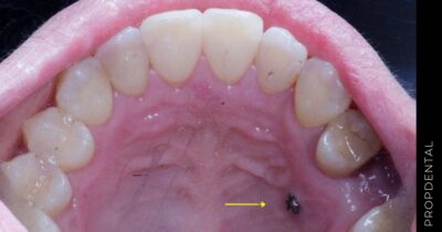 Microimplantes o Microtornillos de ortodoncia