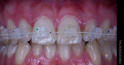 Las complicaciones más comunes de los brackets dentales