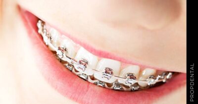 Problemas con brackets: ¿Qué hacer si me duelen los dientes?