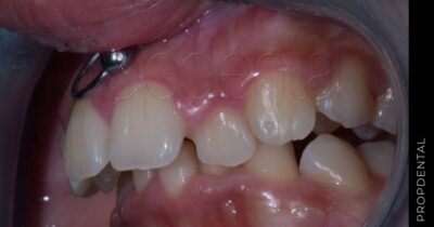 Tratamiento de la sobremordida con ortodoncia lingual
