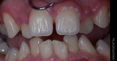 Apiñamiento inferior con ortodoncia lingual