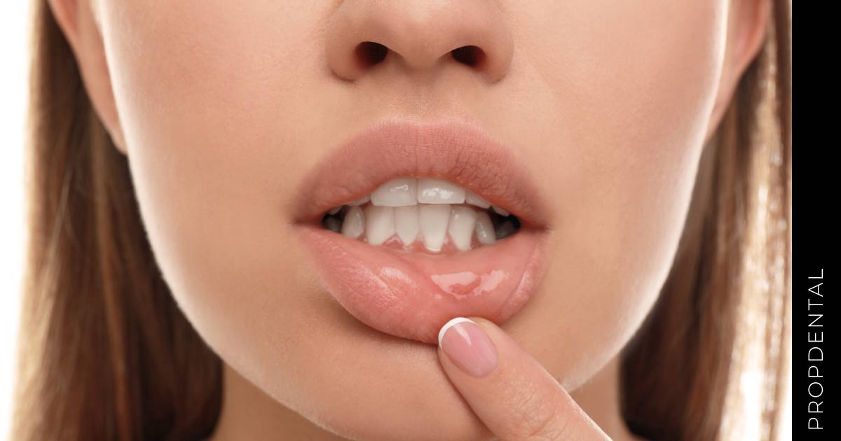 Aftas en la boca por ortodoncia