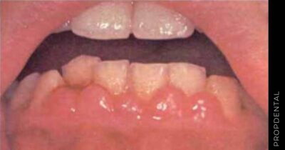 Agrandamiento gingival por ciclosporina