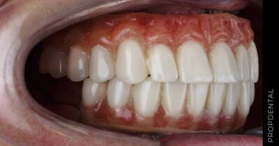 Análisis gingival