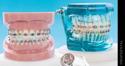 Alternativas a los brackets tradicionales