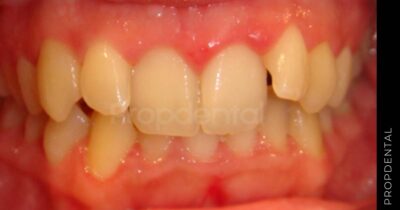 Caso clínico brackets de zafiro