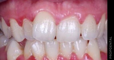 Causas de la gingivitis