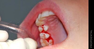 Causas del sangrado gingival