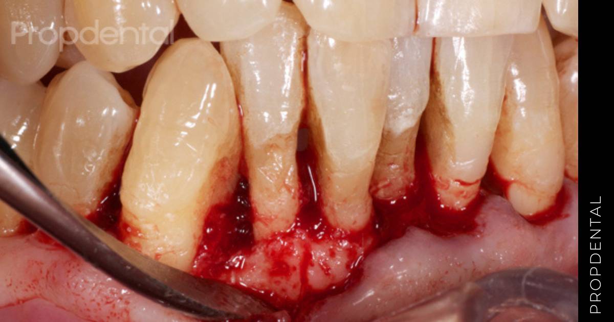 Cirugía periodontal