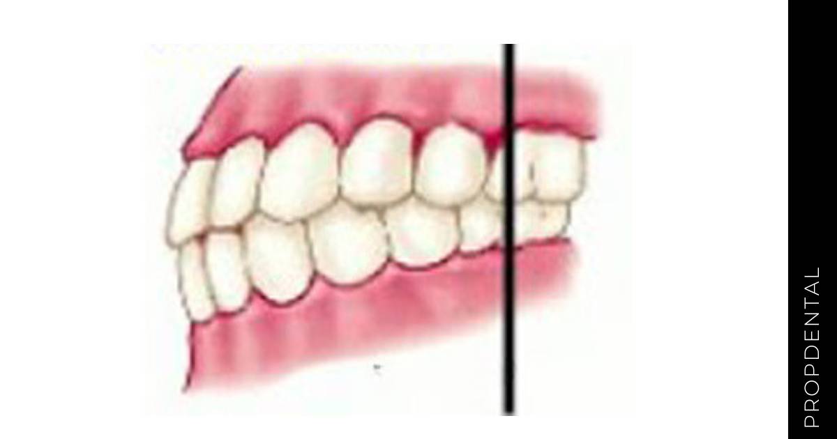 Clasificación Angle