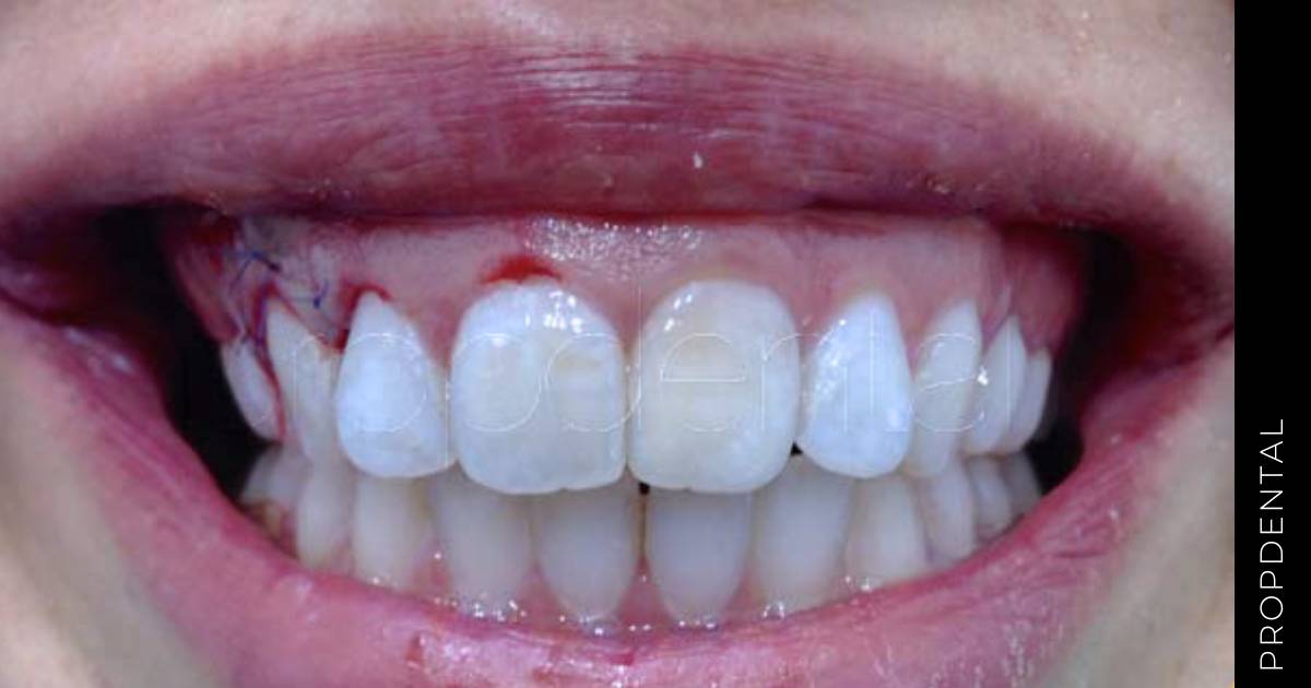 Contorno del margen gingival