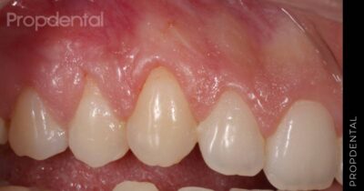 Control de la recesión gingival