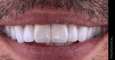 Rehabilitación estética con prótesis de circonio