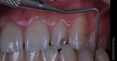 Sangrado al sondaje periodontal