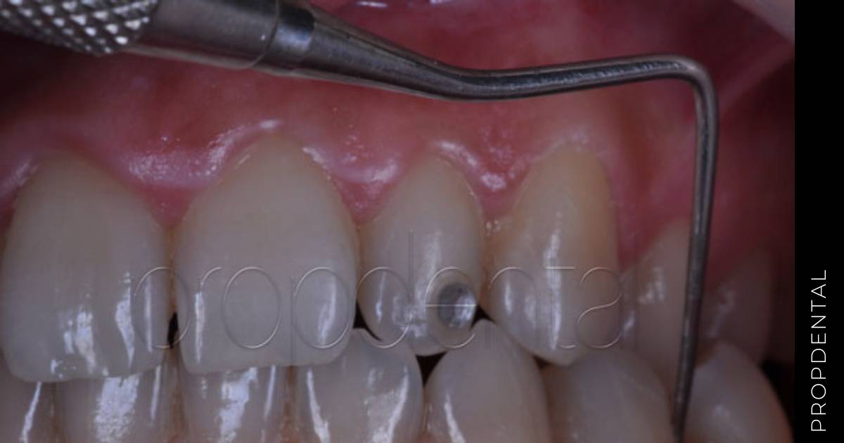 Mantenimiento periodontal