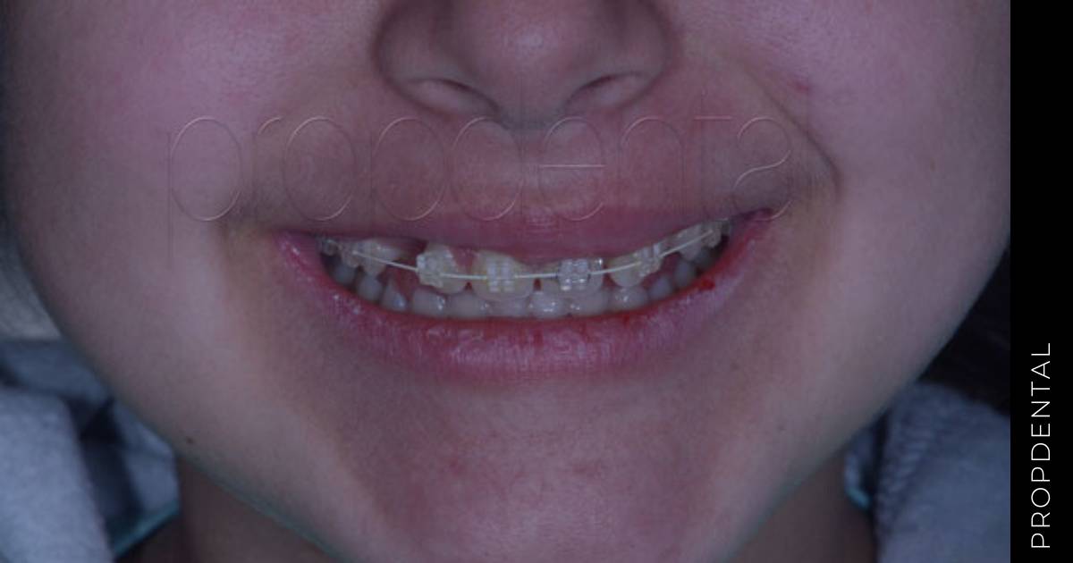 Ortodoncia infantil Barcelona