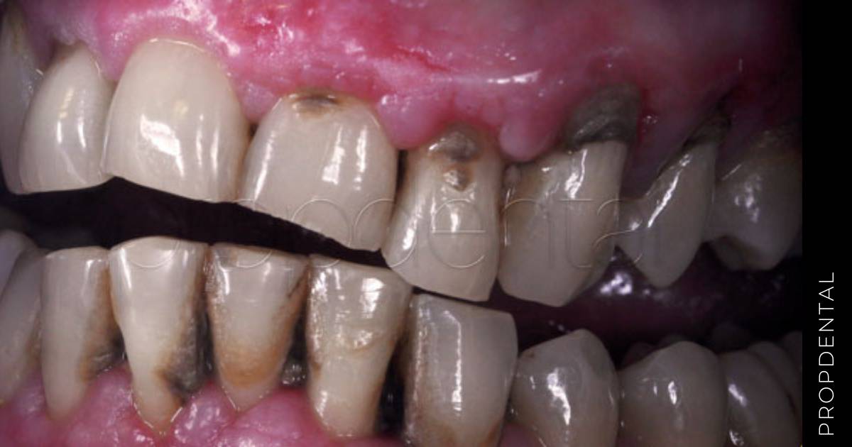 Periodontitis crónica del adulto