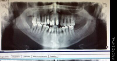 Periodontitis e implantes