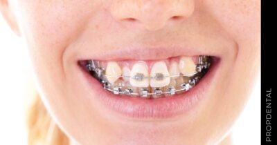 Preguntas frecuentes sobre llevar brackets