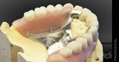 Prótesis parciales removibles: solución parcial para reponer dientes perdidos