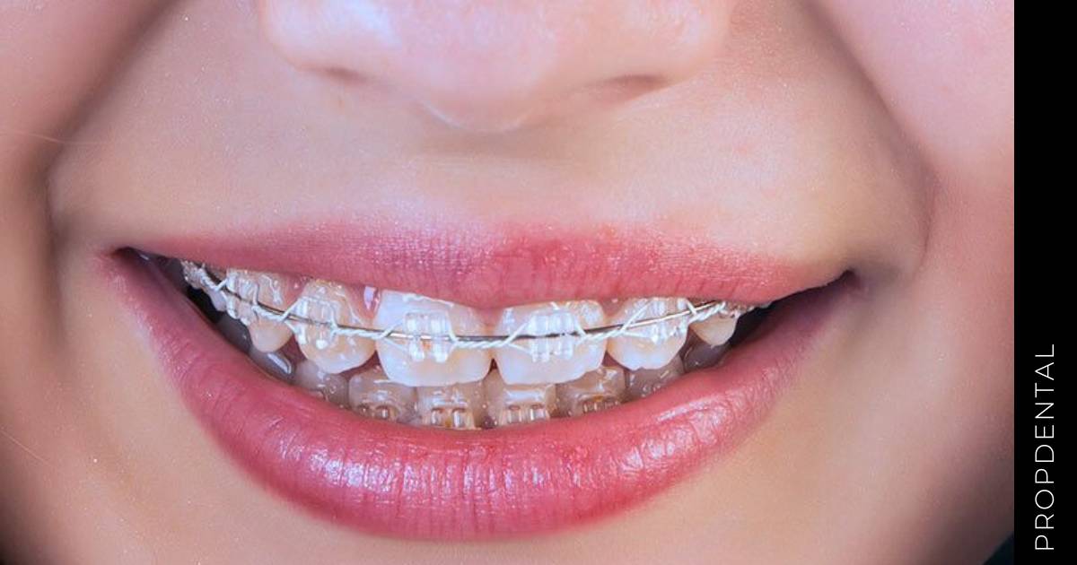 ¿Qué tipo de brackets necesito?