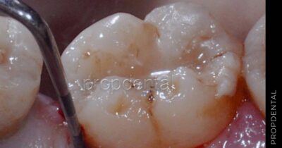 Sondaje periodontal