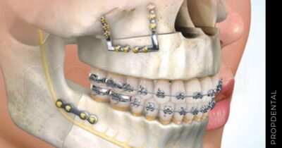 Todo sobre la cirugía de la mandíbula