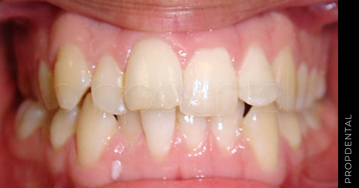 Tratamiento del apiñamiento dental