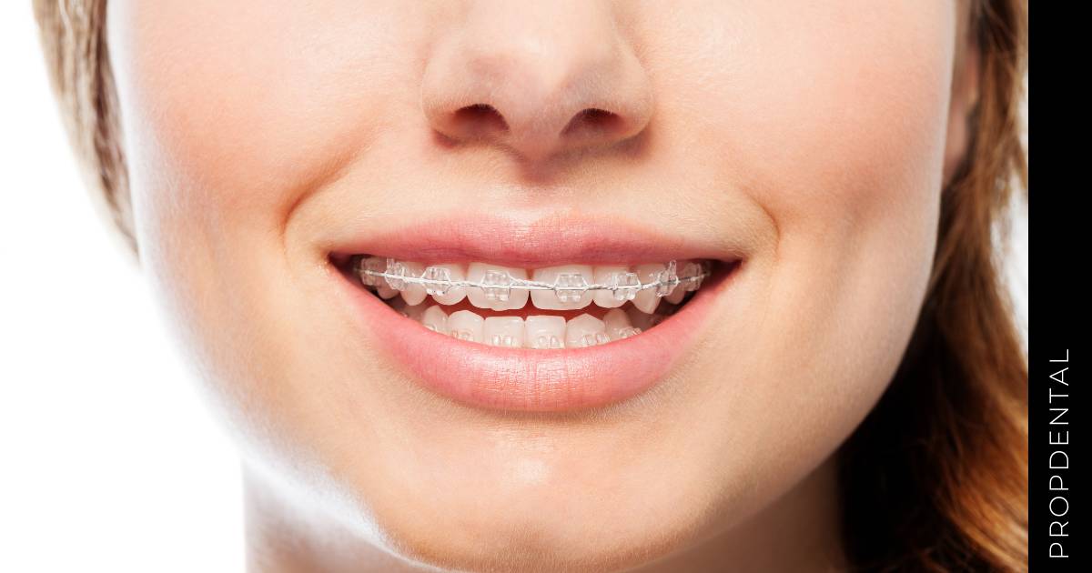 Ventajas de los brackets de porcelana