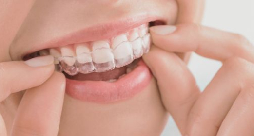 como funciona invisalign