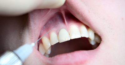 Ácido hialurónico en odontología: Una revolución en el tratamiento dental